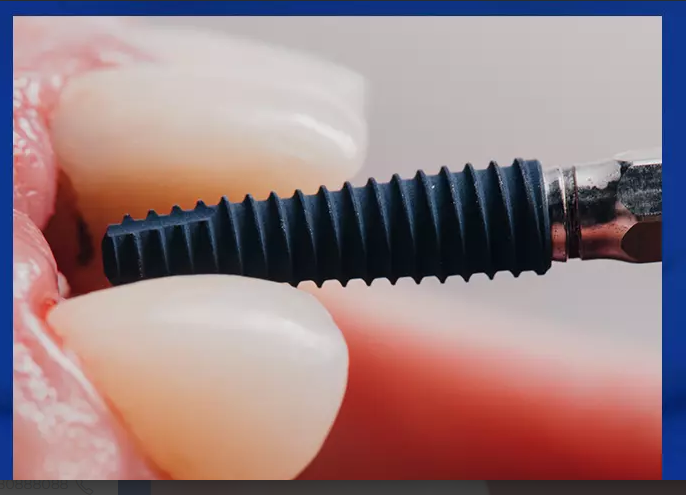 عملية زراعة الاسنان